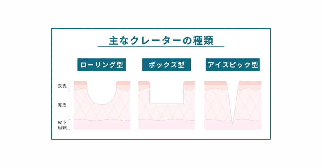 ニキビ跡（クレーター）３種類のイラスト