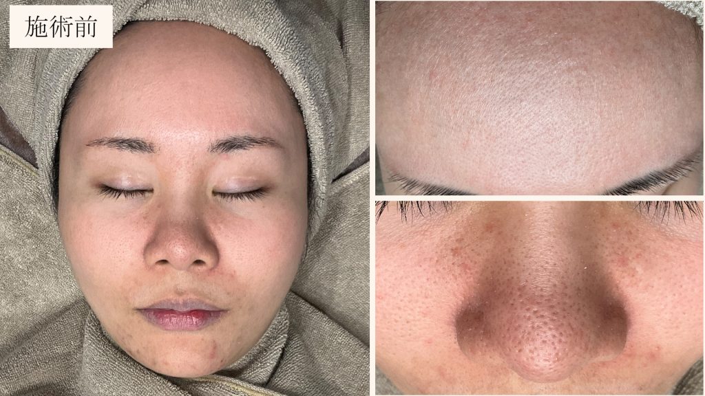ダーマペン施術前