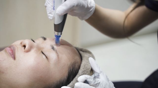 ダーマペンの施術の様子