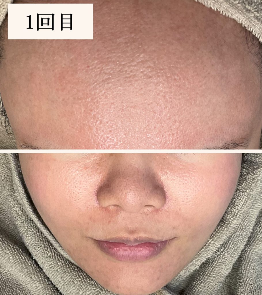 ダーマペン1回目（ダウンタイム後）