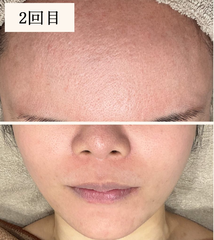 ダーマペン2回目（ダウンタイム後）