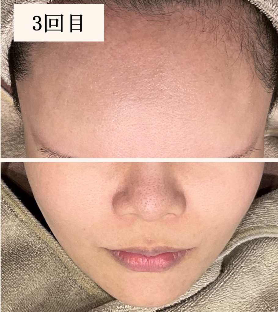 ダーマペン3回目（ダウンタイム後）