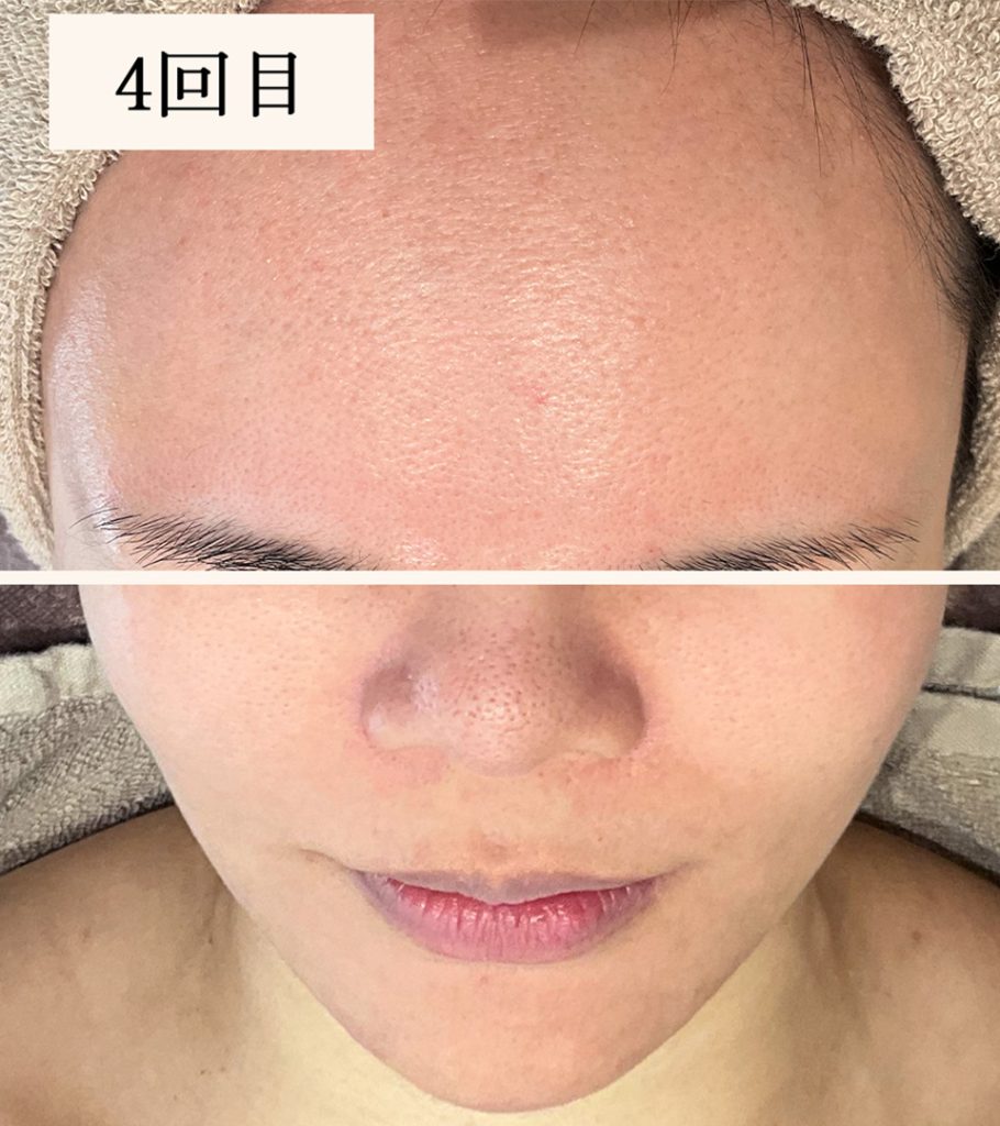 ダーマペン4回目（ダウンタイム後）