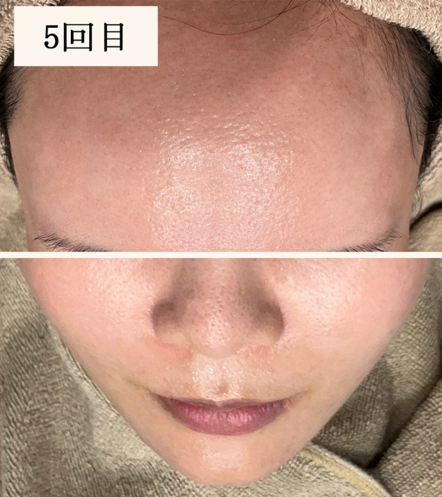 ダーマペン5回目（ダウンタイム後）