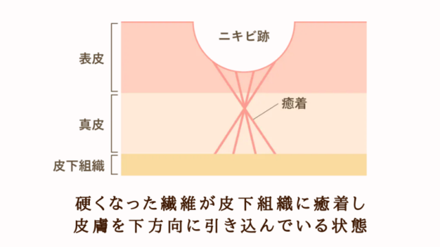 ニキビ跡の凹凸ができる状態