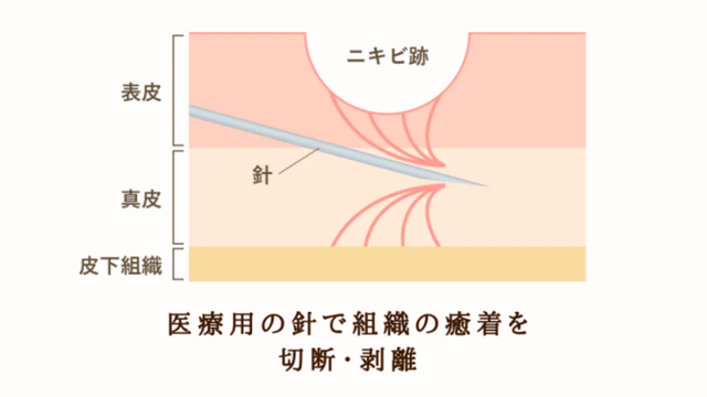 サブシジョンとは？