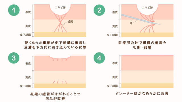 クレーター肌に作用する仕組み