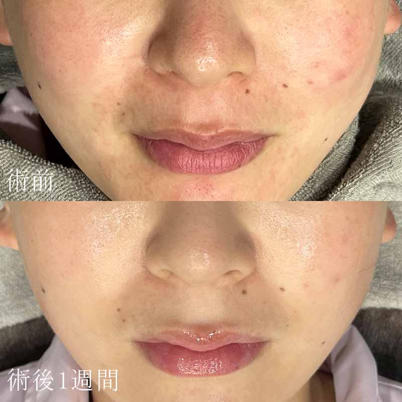 ダーマペンの症例写真