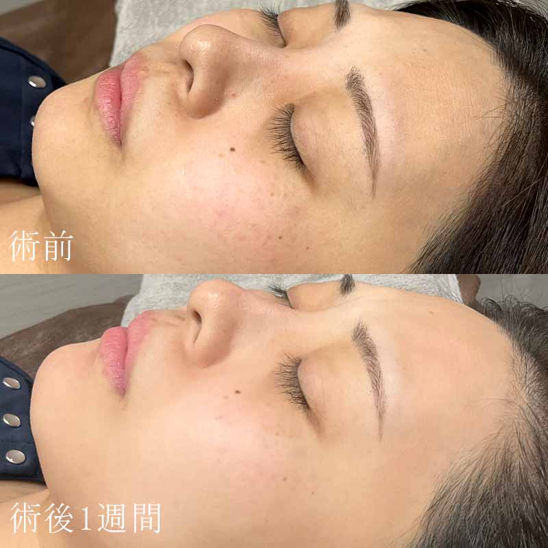 ダーマペン4の症例写真