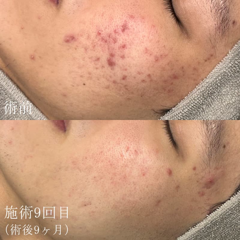 ダーマペン4の症例写真