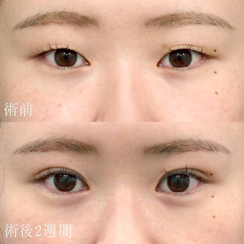二重埋没法と涙袋ヒアルロン酸の症例写真【杉島医師】