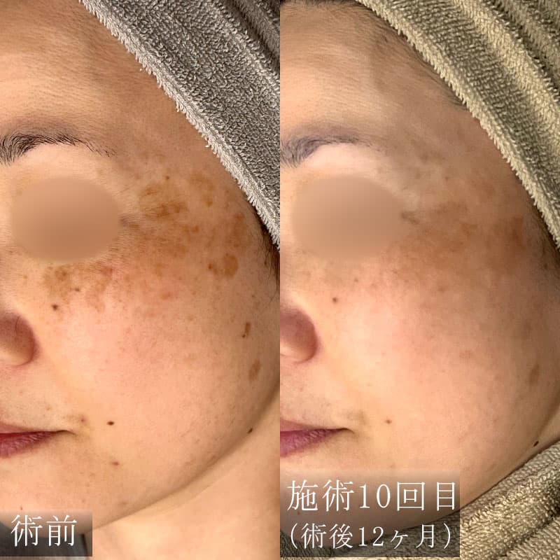 肝斑治療の症例写真