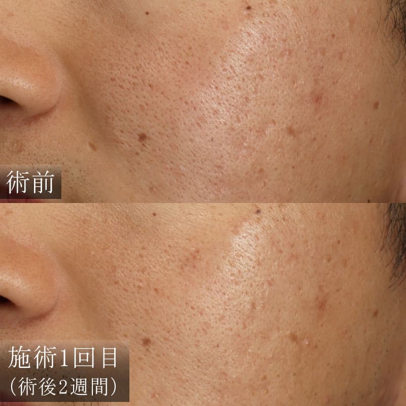 サブシジョンの症例写真