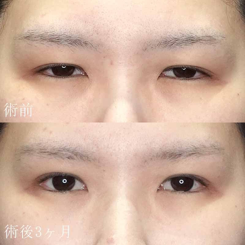 眼瞼下垂の症例写真