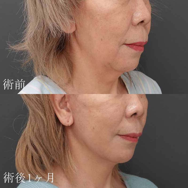 フェイスリフトの症例写真(鈴木医師)