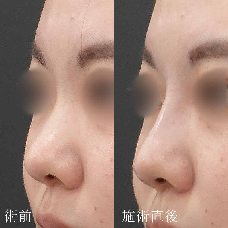 鼻のヒアルロン酸(金子医師)