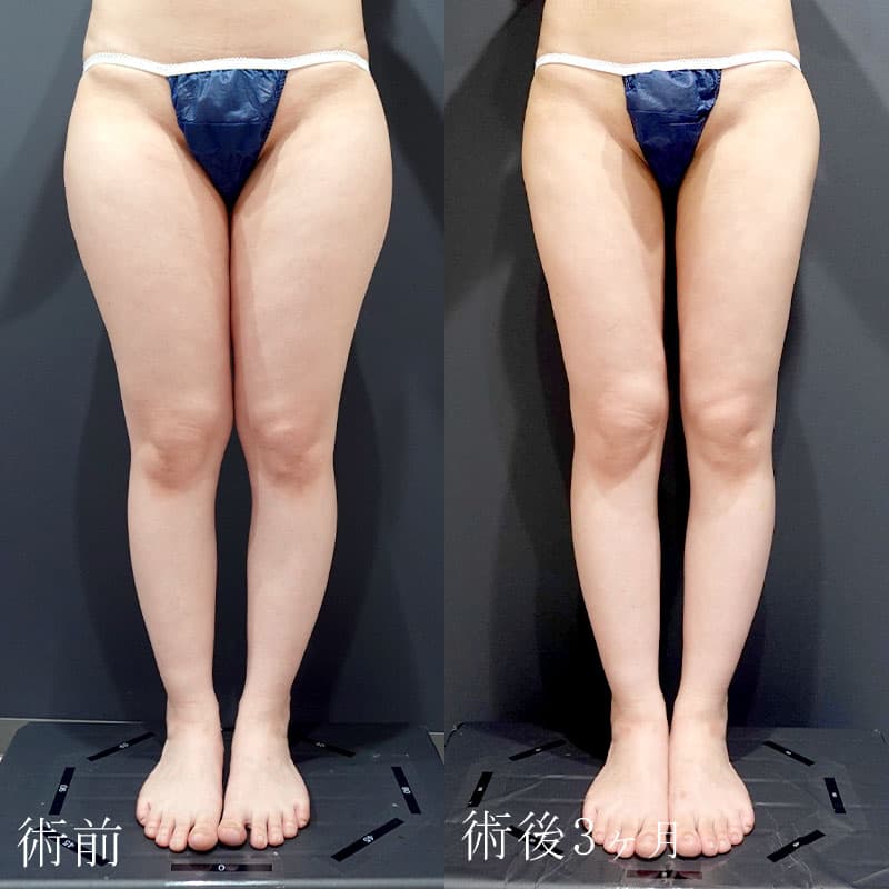 太ももの脂肪吸引　症例写真