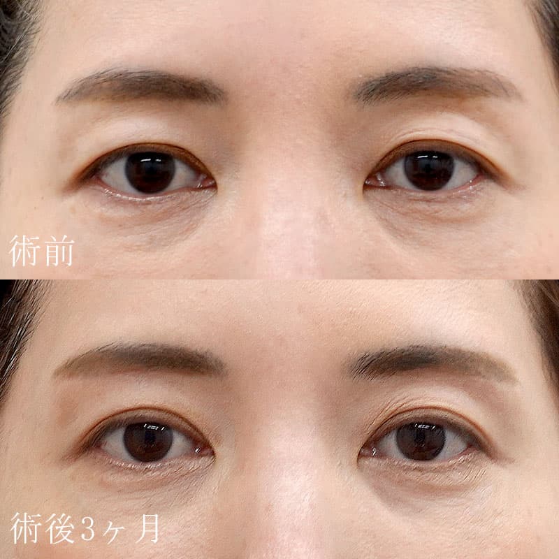 眉下切開の症例写真