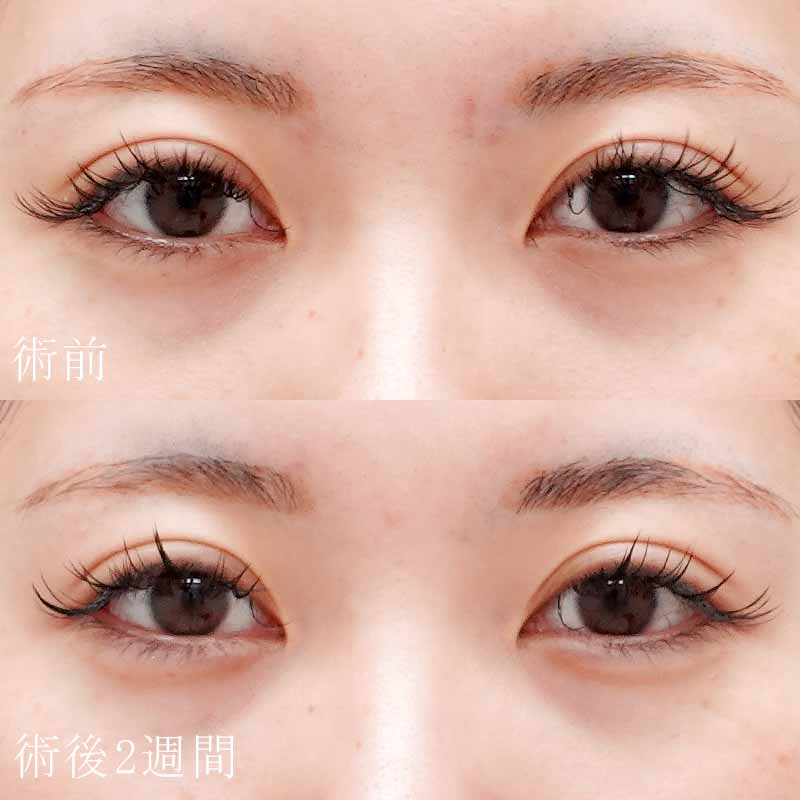 ヒアルロン酸注入症例写真