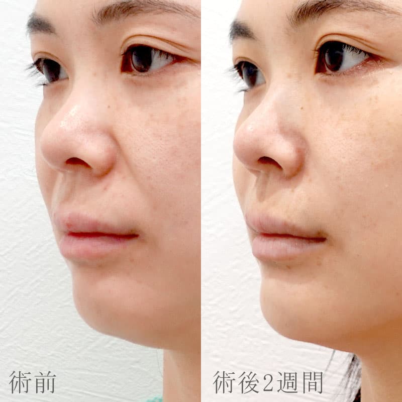 東京銀座院の常盤医師のヒアルロン酸症例