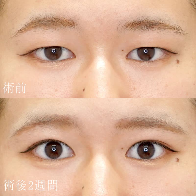 二重埋没法の症例写真