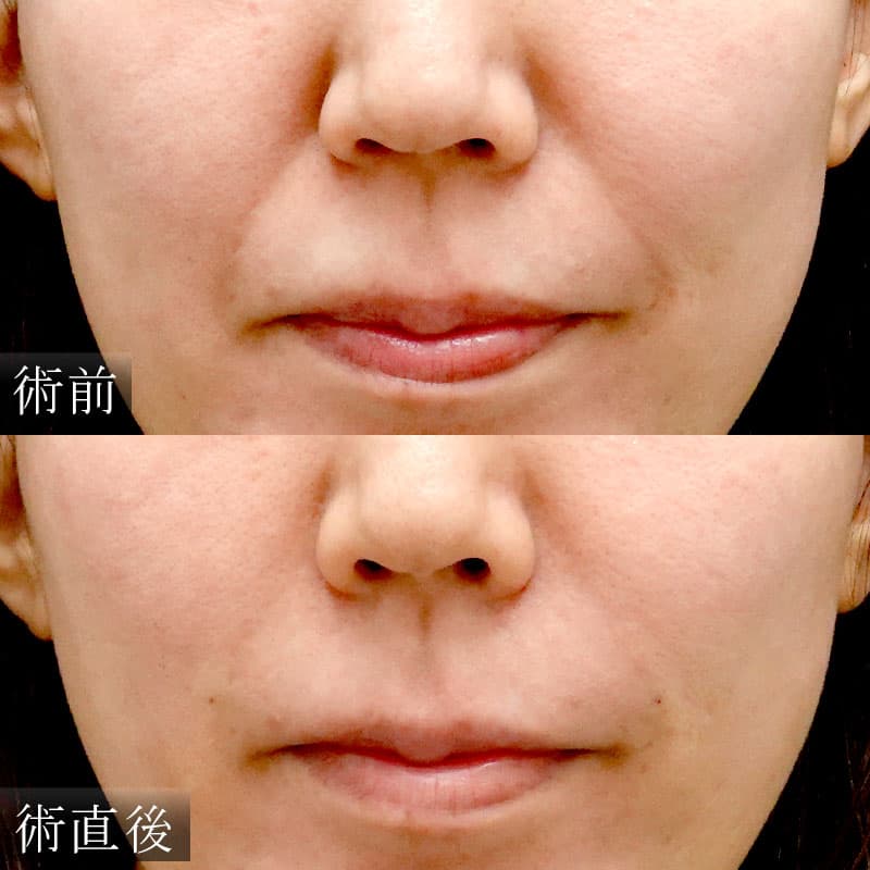 ほうれい線のヒアルロン酸注入(細野医師)