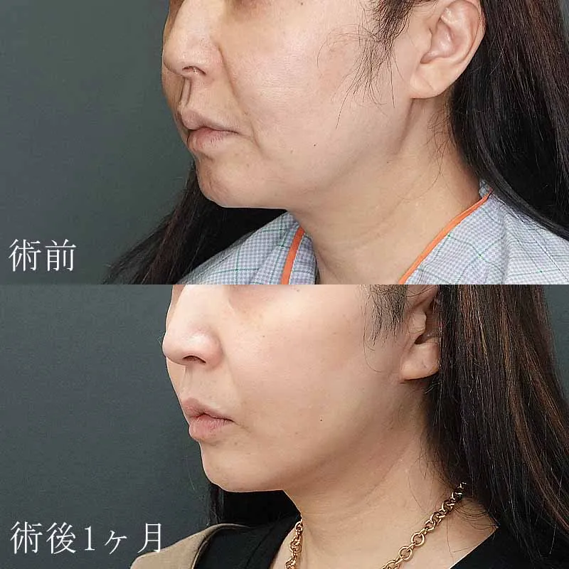 フェイスリフト 症例写真
