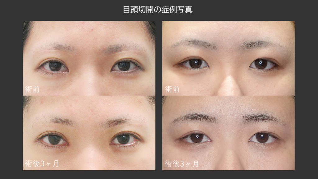 離れ眼が解消する