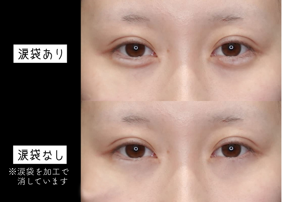 涙袋の必要性①