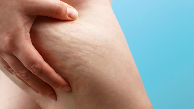 セルライトができる主な原因