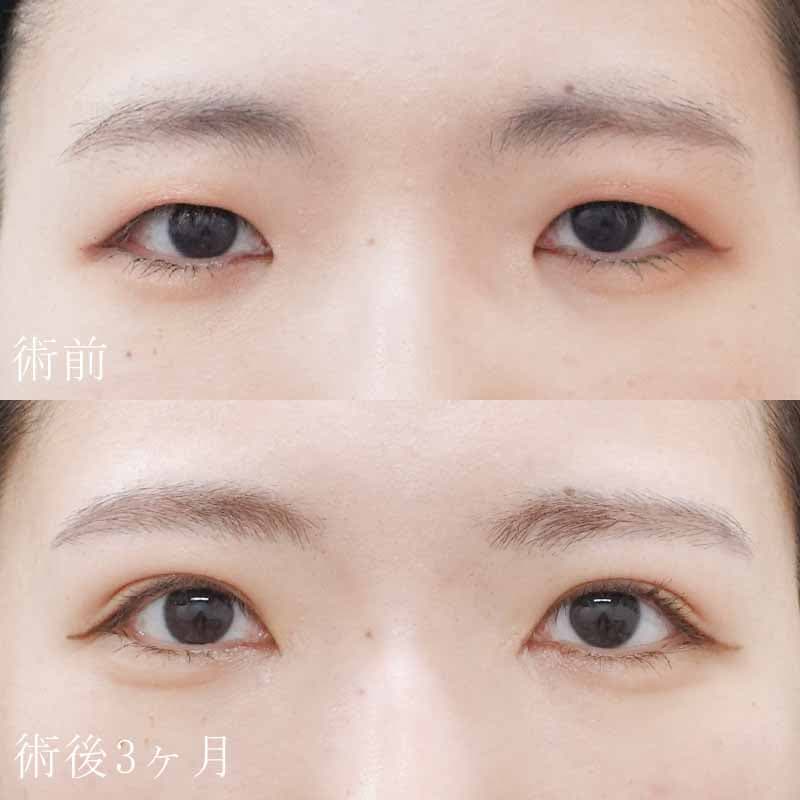 二重埋没法＋目頭切開法の症例写真