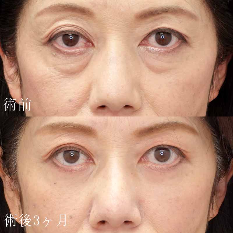 ハムラ法　症例写真