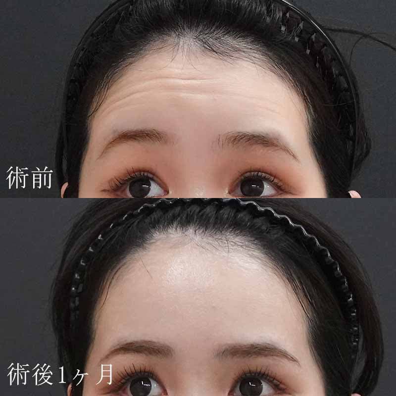 ボトックスの症例写真