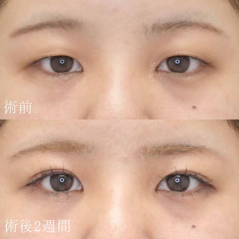 大阪梅田院細野医師の二重埋没法