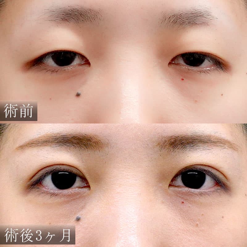 眼瞼下垂手術東京都渋谷院古村陽典院長の症例