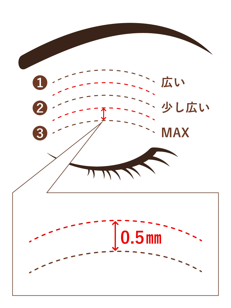 水の森美容クリニックの二重幅デザインの間隔