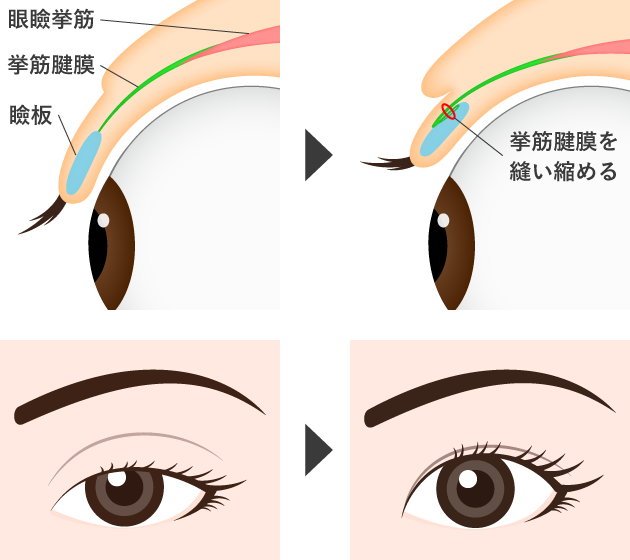 眼瞼下垂の手術の内容を紹介したイラスト