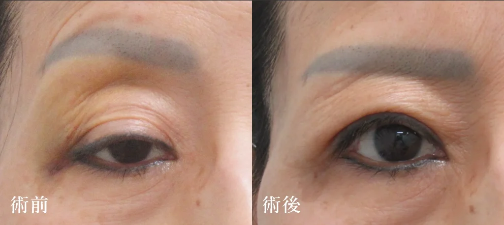 眼瞼下垂手術の症例