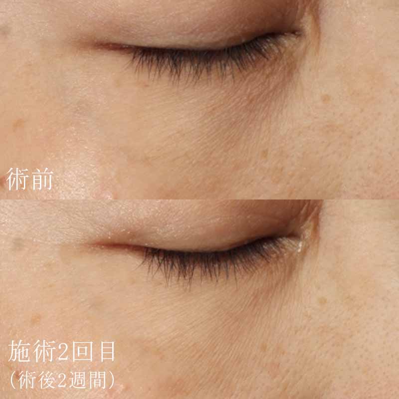 デンシファイ　症例写真