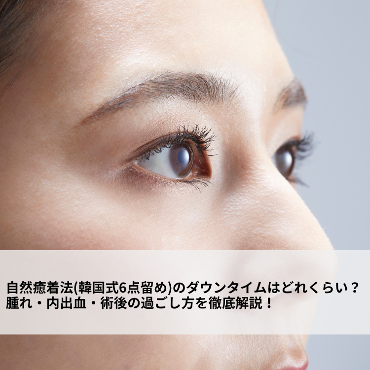 自然癒着法(韓国式6点留め)のダウンタイムはどれくらい？腫れ・内出血 