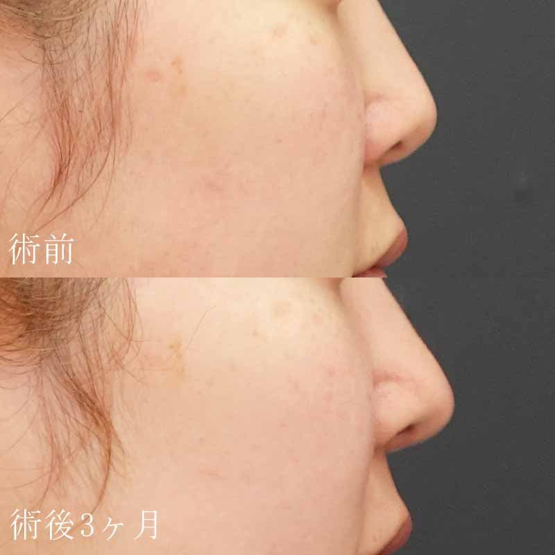 鼻尖縮小+耳介軟骨移植の症例写真①