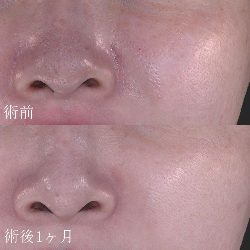 20251122_St20251122-5_fukuda_micro-botoxメイン横