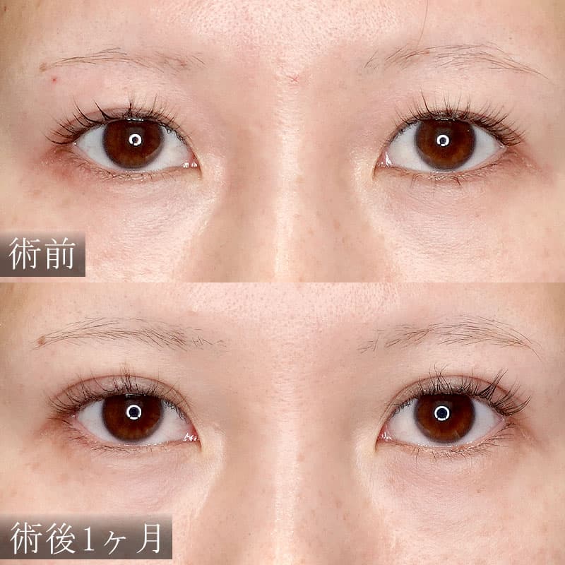 自然癒着法の症例写真