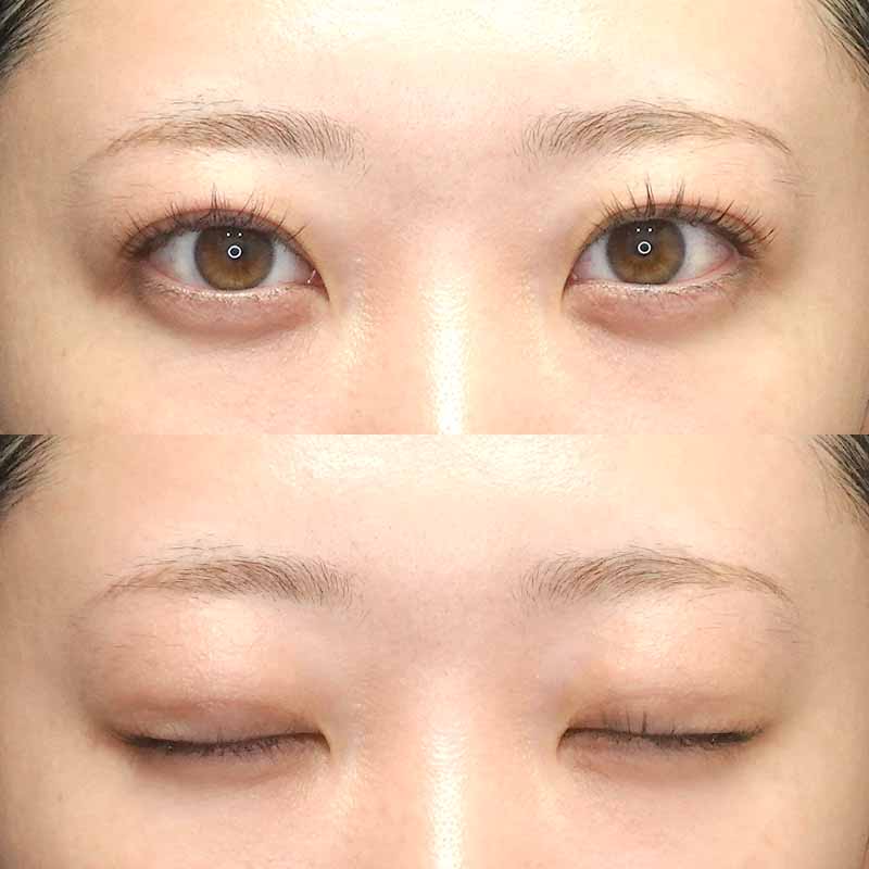 自然癒着法ダウンタイム１ヵ月目