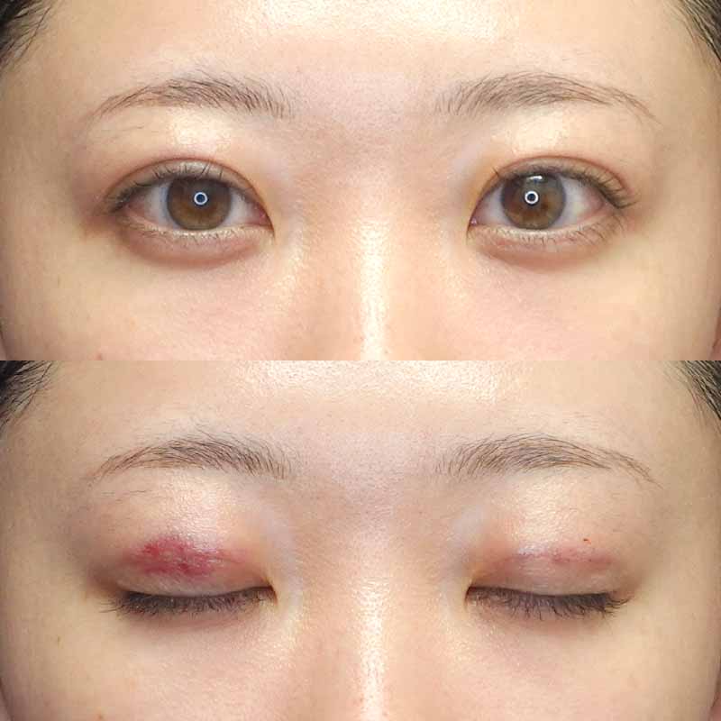 自然癒着法ダウンタイム翌日