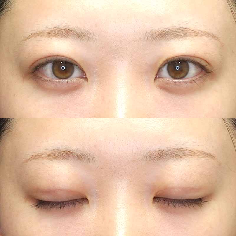 自然癒着法ダウンタイム14日目