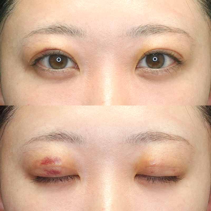 自然癒着法ダウンタイム3日目