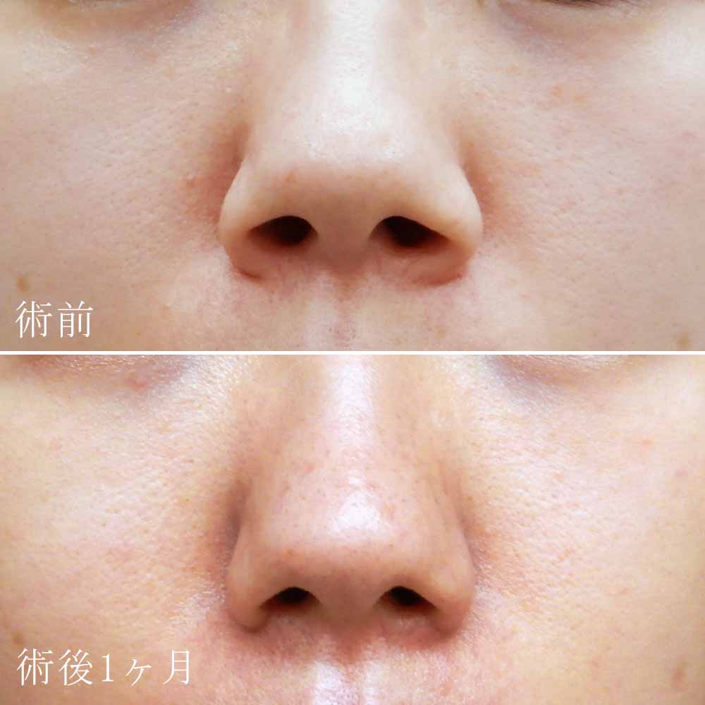小鼻縮小の症例写真