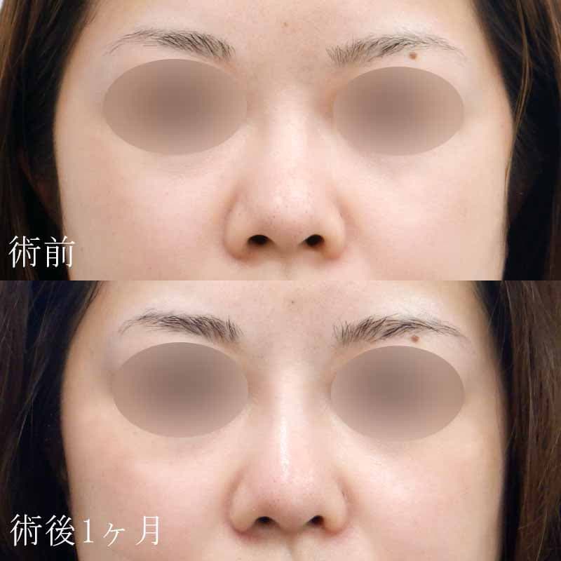 鼻のプロテーゼ＋小鼻縮小の症例写真