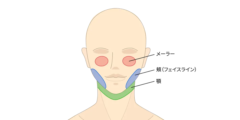 顔の脂肪吸引で吸引する部位のイラスト